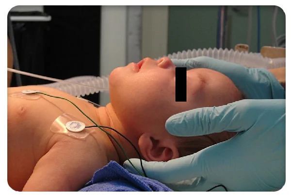 Pediatric Upper Airway Surgery